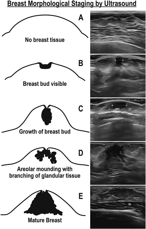 skinny teen big boobs|Breast development: Stages and how to spot growth signs .